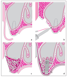 SINUS LIFT